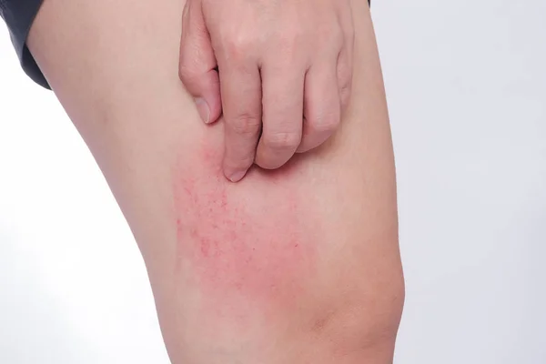 Подряпати алергічну шкіру від укусів комарів — стокове фото