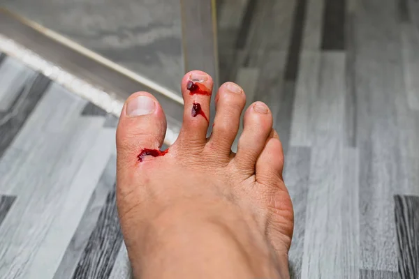 Herida a pie por accidente caminando en un lugar desordenado y desorganizado — Foto de Stock