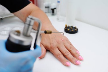 Dermatoloji Kliniği siğil kaldırılması