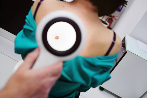 El dermatólogo examina los lunares de los pacientes con la ayuda de una lupa electoral especial . — Foto de Stock