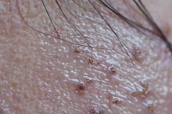 Skin detail of asian woman after laser treatment acne