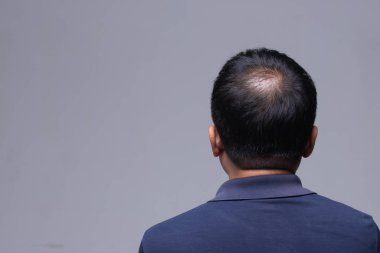 Saç dökülmesinin ilk aşaması orta yaşlı bir işçiye düşmek, saç terapisi sorunu olan bir erkeğin arka planda oturması, arka planda gri arka plan fotokopi alanı aydınlatması.
