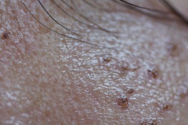 Lazer tedavisinden sonra Asyalı kadının cilt ayrıntıları sivilce ve çil, seçici odaklanma