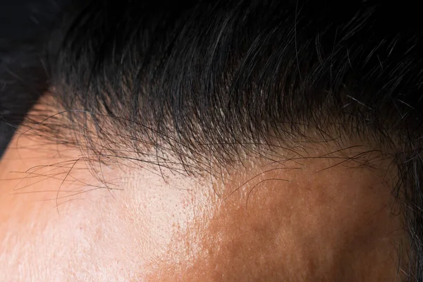 Closeup macro portrait of male hair head part, Human man open thin hair area on back top circle area head to see natural skin wrinkle, root, scalp and problem of thin hair, almost bald