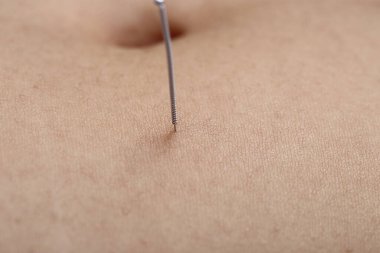 Beauty Spa 'daki profesyonel akupunktur tedavisini kapat. Vücut, mide, karın... Çin İğne Enstitüsü' nden uzman güzellik uzmanının yağlarını azaltır. Yaşlanma karşıtı konsept.