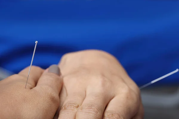 Close Hand Uitvoeren Medische Van Professionele Acupunctuur Behandeling Beauty Spa — Stockfoto