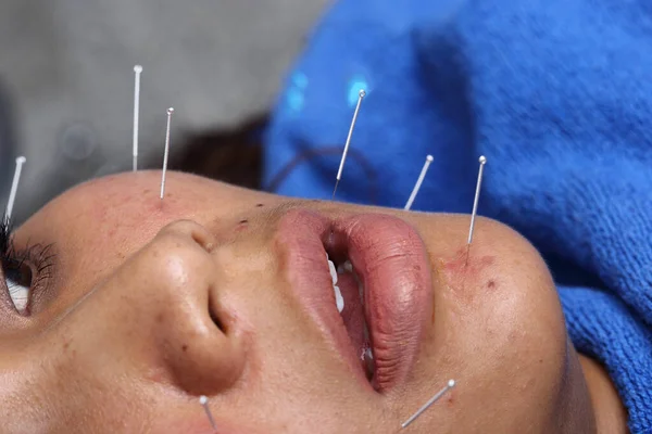 Close up Hand Perform Medical of professional acupuncture treatment in Beauty spa on face, cheek, forehead, chin, lip from expertise beautician from Chinese Needle institute, concept anti aging