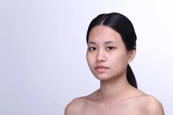 Femme Asiatique Avant Maquiller Sans Retouche Visage Frais Avec Acné — Photo