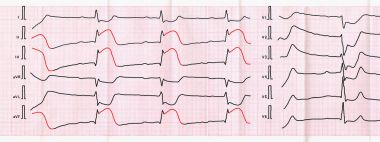 EKG teyp macrofocal posterior diyafragmatik miyokard infarktüsü keskin süresi ile