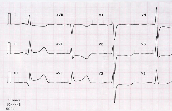ECG ระยะเฉียบพลันของกล้ามเนื้อหัวใจตายหลังขนาดใหญ่ — ภาพถ่ายสต็อก