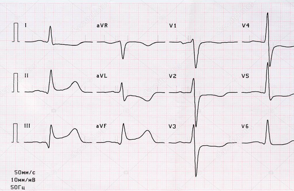 ECG with acute period of large-focal posterior diaphragmatic myocardial infarction