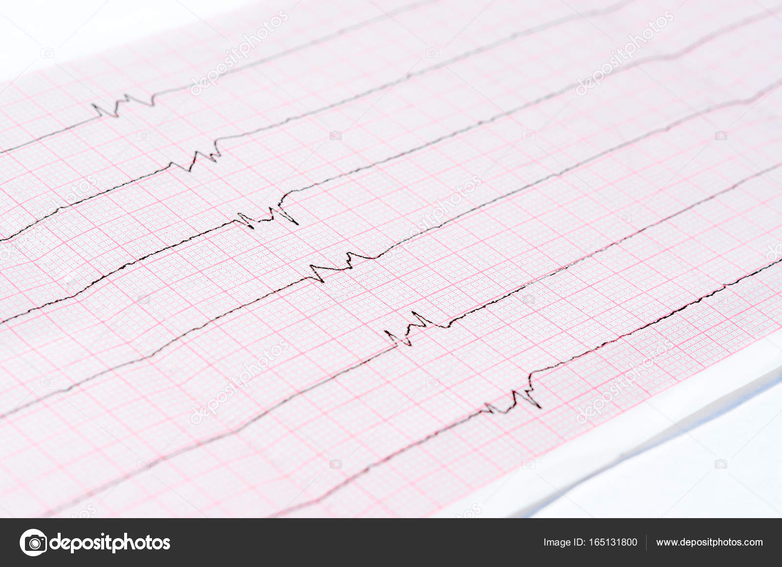 Ecg With Single Ventricular Complexes And Ventricular Asystole Dying Heart Stock Photo Image By C Olga355 Ecg With Single Ventricular Complexes And Ventricular Asystole Dying Heart Stock Photo Image By C Olga355