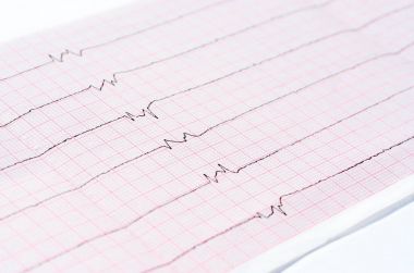 EKG tek ventrikül kompleksleri ve ventrikül asistoli 