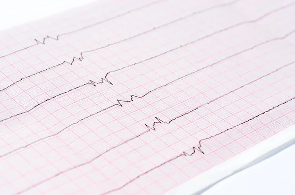 EKG tek ventrikül kompleksleri ve ventrikül asistoli 