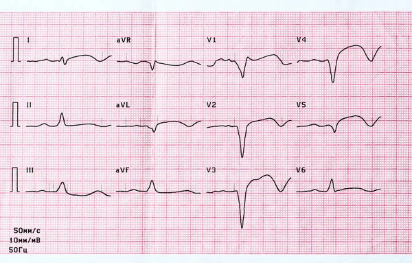 ECG with acute period of large-focal widespread anterior myocardial infarction — Stock Photo, Image