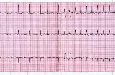 EKG Supraventriküler extrasystole ve Atriyal Fibrilasyonun kısa paroxysm
