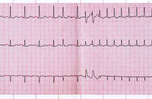 EKG se supraventrikulární extrasystol a krátký záchvat fibrilace síní — Stock fotografie