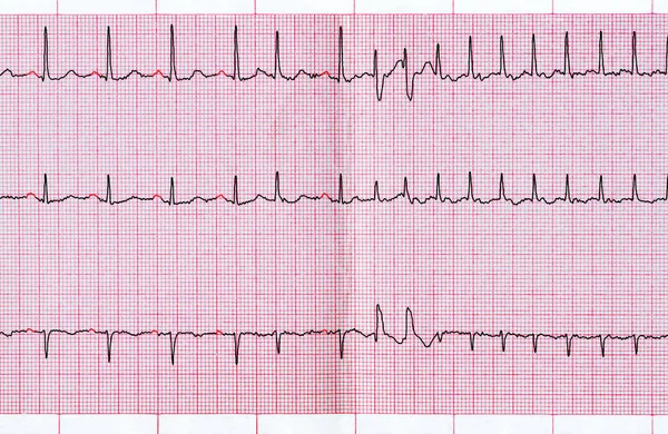 ECG con extrasistolia sopraventricolare e parossismo corto della fibrillazione atriale — Foto Stock