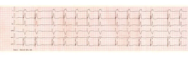 ECG com arritmia de marca-passo (estimulação ventricular ) — Fotografia de Stock