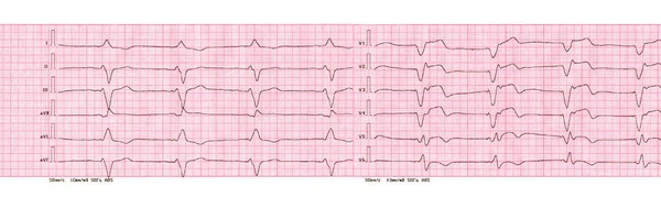 ECG with rhythm of artificial pacemaker (ventricular pacing) — Stock Photo, Image