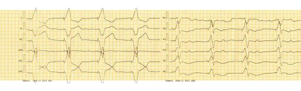 ECG con ritmo di pacemaker artificiale (stimolazione ventricolare ) — Foto Stock