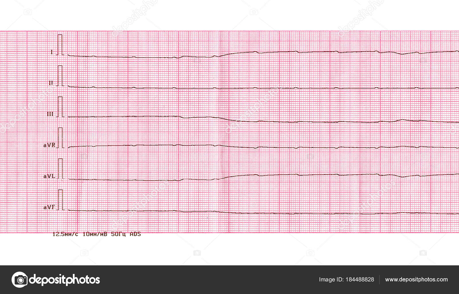 Emergency Cardiology And Resuscitation Ecg With Ventricular Asystole Stock Photo Image By C Olga355 Emergency Cardiology And Resuscitation Ecg With Ventricular Asystole Stock Photo Image By C Olga355