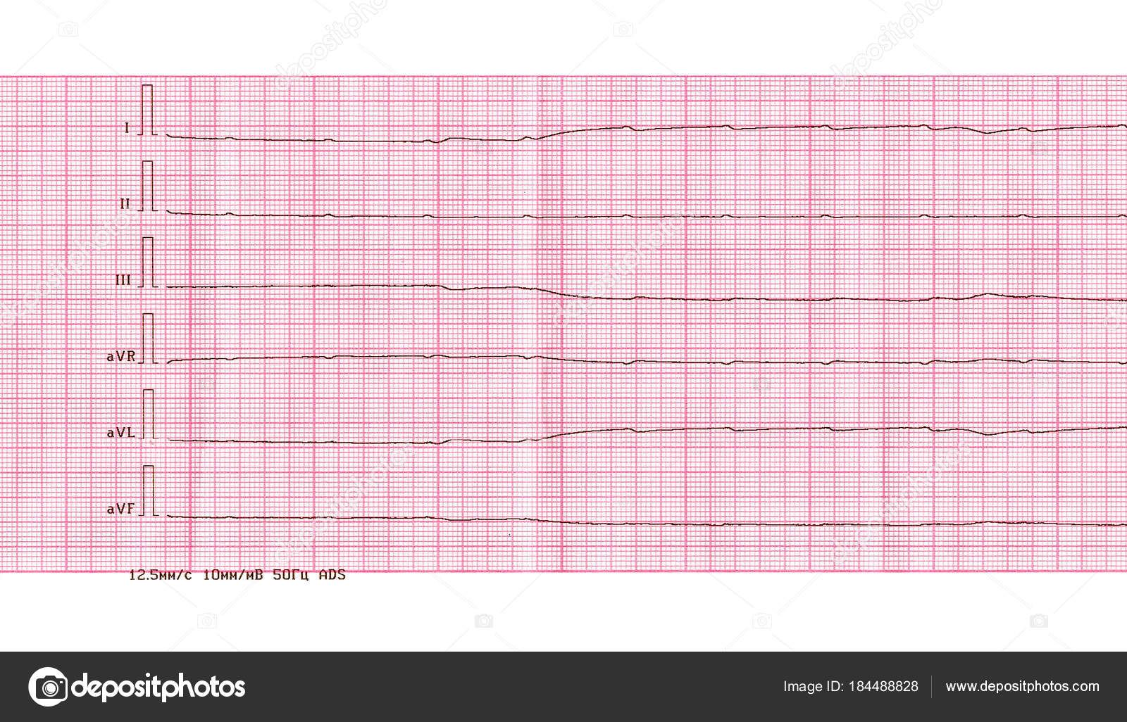 Emergency Cardiology And Resuscitation Ecg With Ventricular Asystole Stock Photo Image By C Olga355