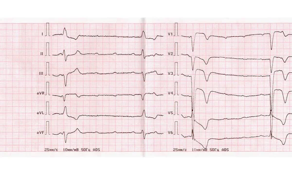 ECG with acute period of myocardial infarction, complete atrioventricular blockade — Stock Photo, Image