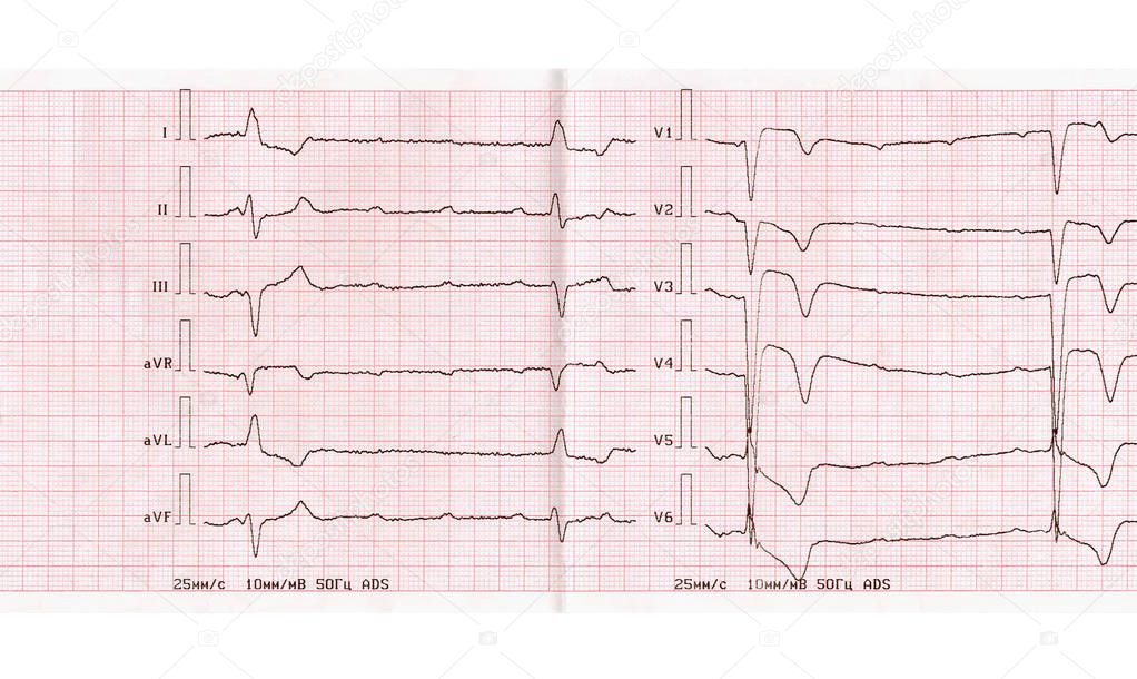 ECG with acute period of myocardial infarction, complete atrioventricular blockade