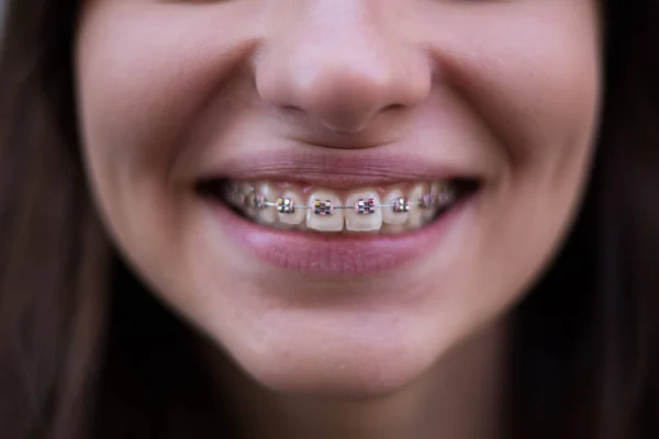 Hermosa Joven Con Abrazaderas Dentales Metal Con Dientes Blancos —  Fotos de Stock