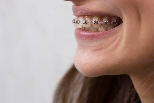 Beautiful young girl with metal dental braces with white teeth