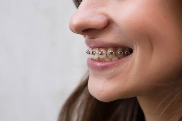 Hermosa Joven Con Abrazaderas Dentales Metal Con Dientes Blancos — Foto de Stock