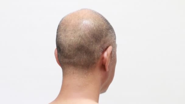 Plan Arrière Une Tête Masculine Cheveux Fins — Video