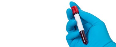 Corona virüsü salgını. Salgın Virüsü Solunum Sendromu.