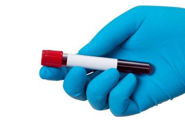 Corona virüsü salgını. Salgın Virüsü Solunum Sendromu.