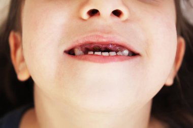 Diş hekimliği. Ağzı açık bir çocuk hasarlı dişleri temizler. Seçici odak