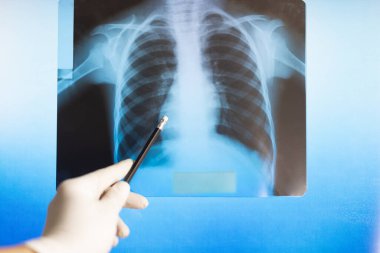 Doktor hastanede bir röntgen fotoğrafını inceliyor.