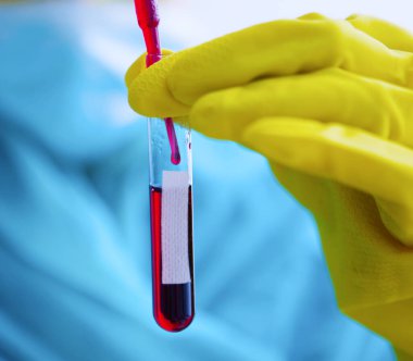 Laboratuvarda Coronavirus hastalığı (COVID-19) kan örneği bulundu. Virüs örneği laboratuvarda. Doktor yeni virüsü test ediyor. 