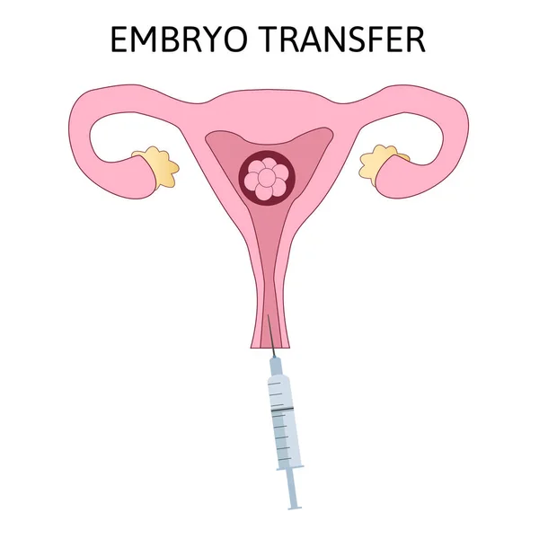 배아는 인공수정으로 외딴곳에 주사기와 수술을 전달한다 — 스톡 벡터