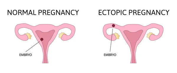 Embarazo Ectópico Normal Óvulo Fertilizado Útero Útero Ilustración Anatomía Muestra — Vector de stock