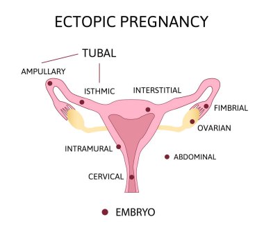 Ectopic Pregnancy. Types of Tubal pregnancy, ovarial, abdominal, clipart