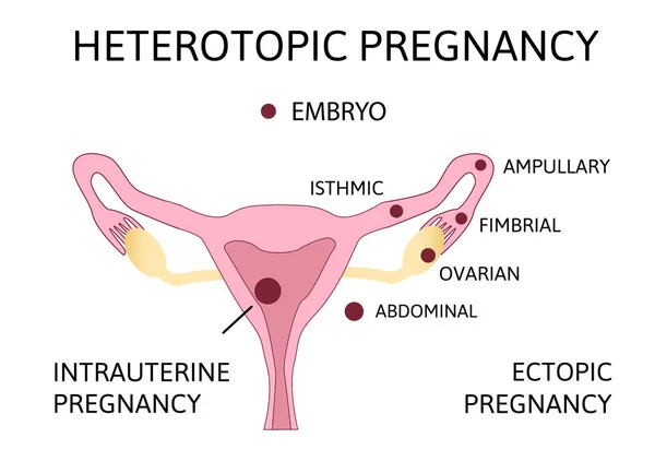 Gravidez heterotópica. gravidez ectópica extra-uterina e gravidez intra-uterina ocorrem simultaneamente — Vetor de Stock