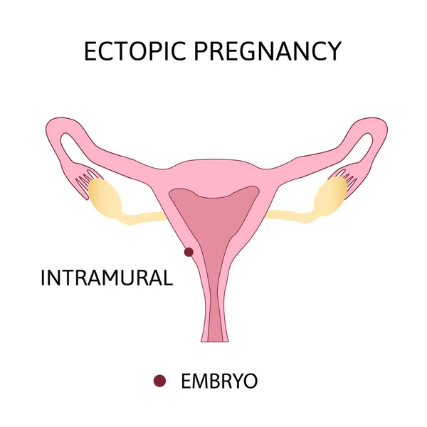 Gravidez ectópica. Tipos de gravidez extra-uterina. Intramural . — Vetor de Stock