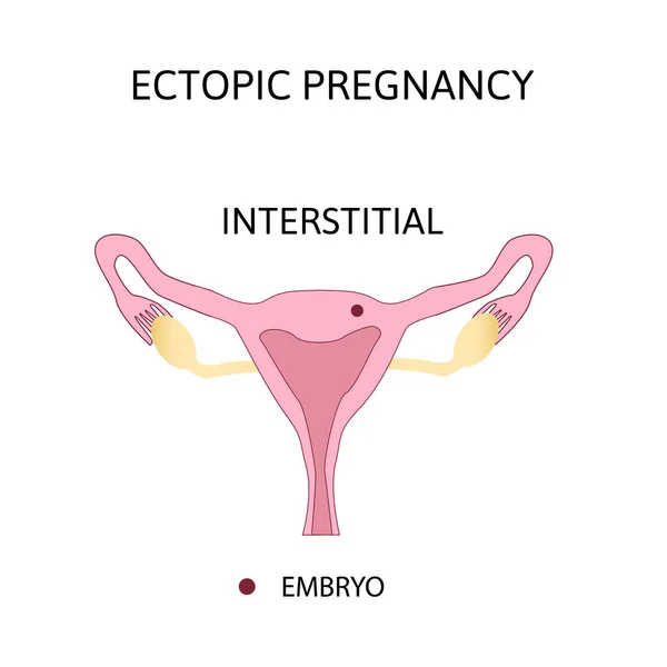 Ектопічна вагітність. Типи позаматкової вагітності є інтерстиціальними . — стоковий вектор