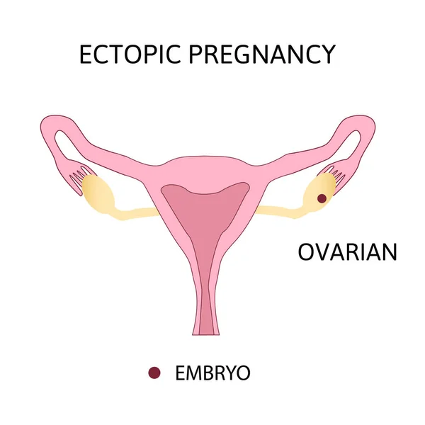 Embarazo ectópico. Tipos de embarazo extrauterino, ovárico — Archivo Imágenes Vectoriales