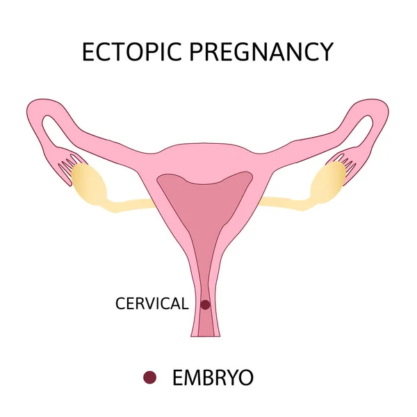 Embarazo ectópico. Tipos de embarazo tubular, ovárico, abdominal, cervical. diagrama médico con repr femenino — Archivo Imágenes Vectoriales