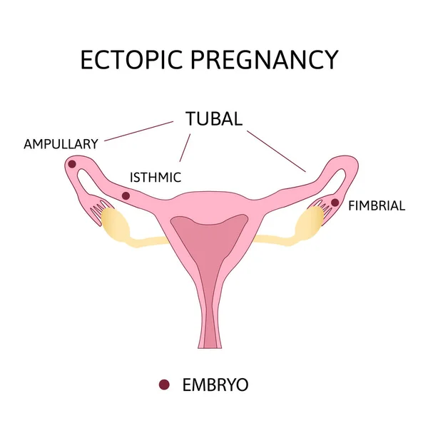 Ектопічна вагітність. Типи вагітності в тубалі, яєчнику, плоскогір'ї . — стоковий вектор