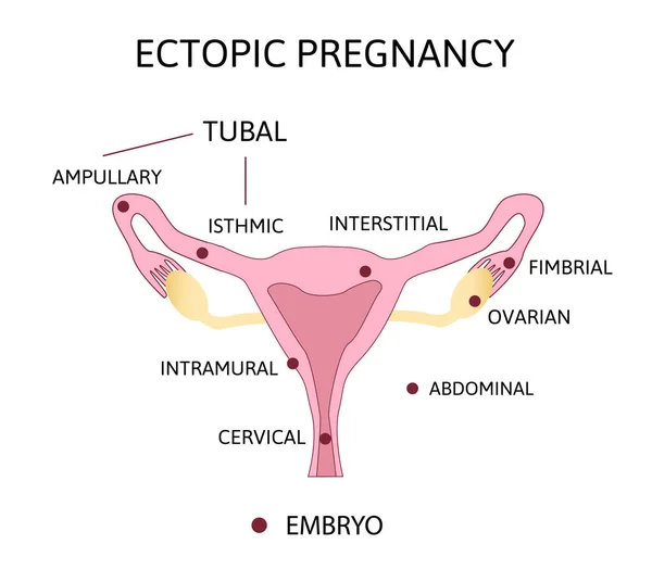 Ectopische Zwangerschap. Soorten Tubale zwangerschap, ovariale, abdominale, — Stockvector