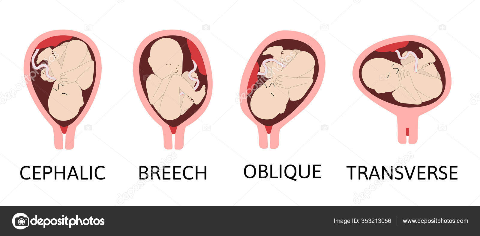 Unterschiedliche Babypositionen Der Geb rmutter W hrend Der unterschiedliche-babypositionen-der-geb-rmutter-w-hrend-der