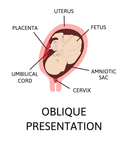 임신중에 자궁내의 위치가 다르다 Cephalic Breech Transverse Whique 거짓말 그림을 — 스톡 벡터